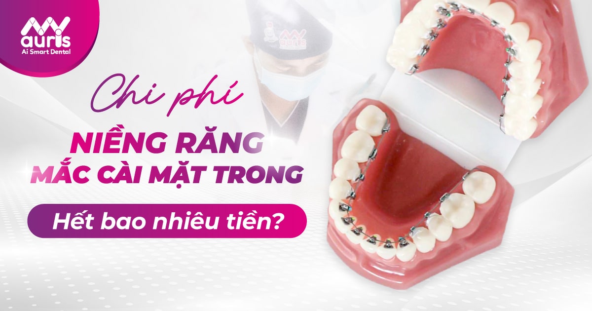 chi phí niềng răng mắc cài trong