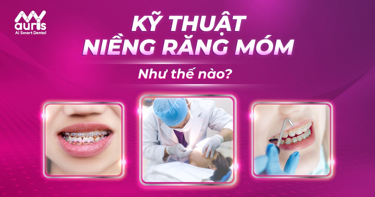 kỹ thuật niềng răng móm