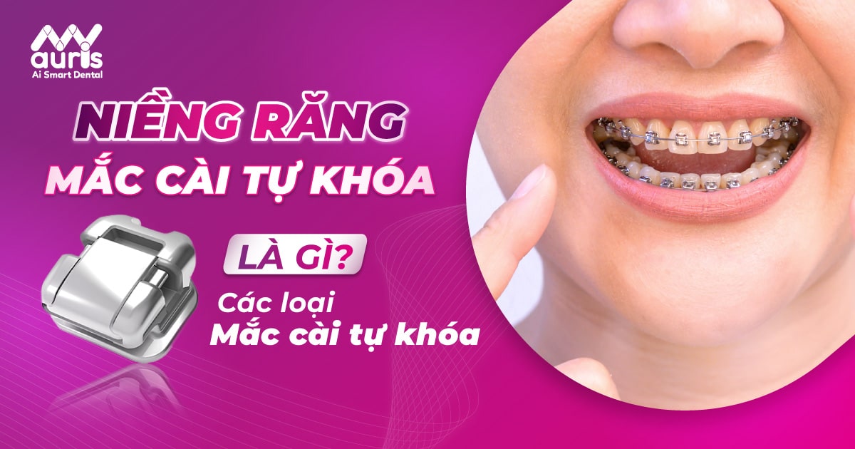 niềng răng mắc cài tự khóa