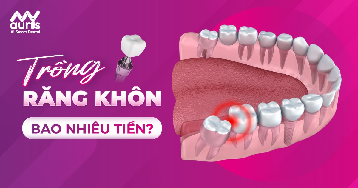 trồng răng khôn bao nhiêu tiền