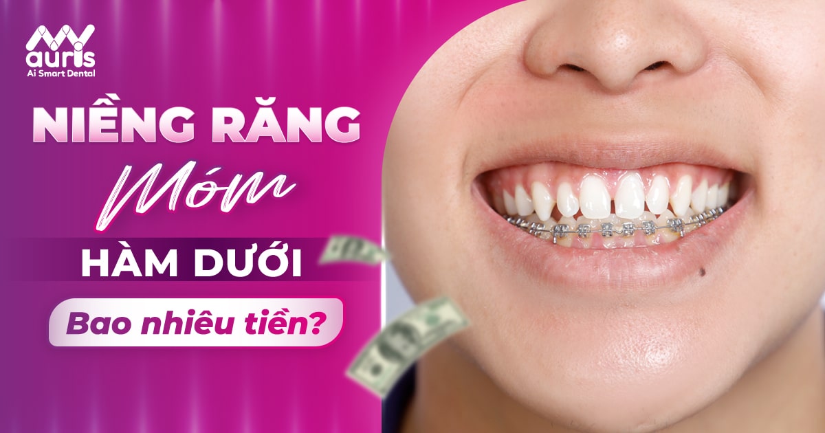 niềng răng móm hàm dưới bao nhiêu tiền