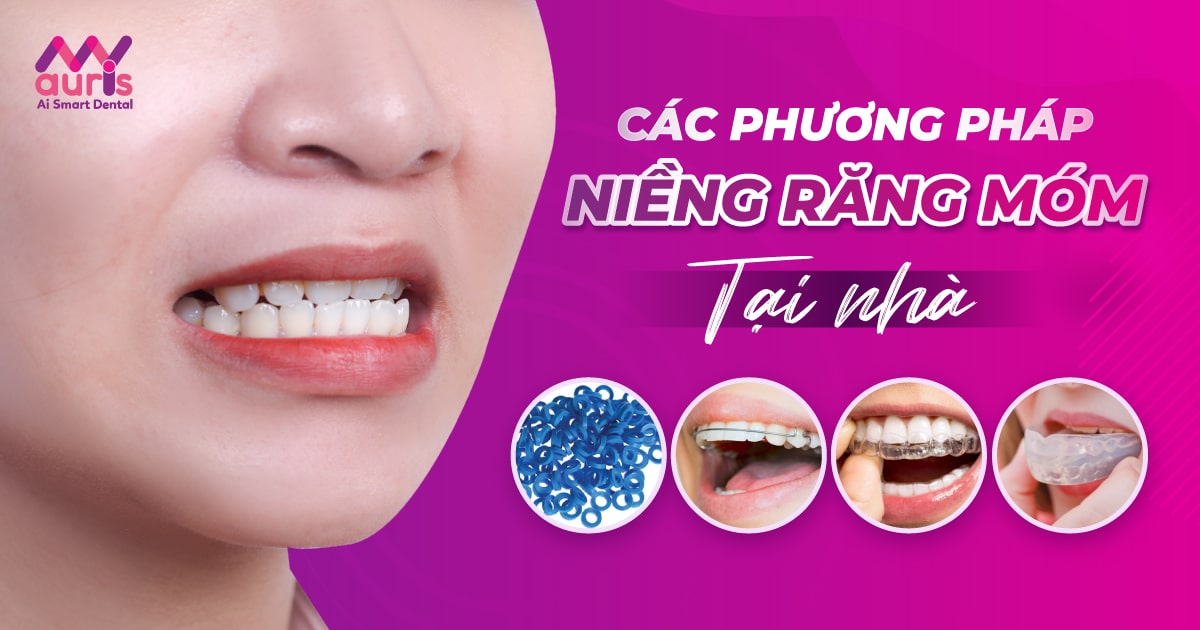 niềng răng móm tại nhà