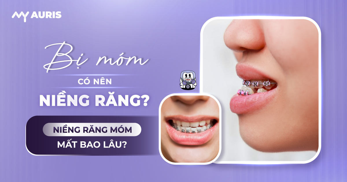 bị móm có nên niềng răng