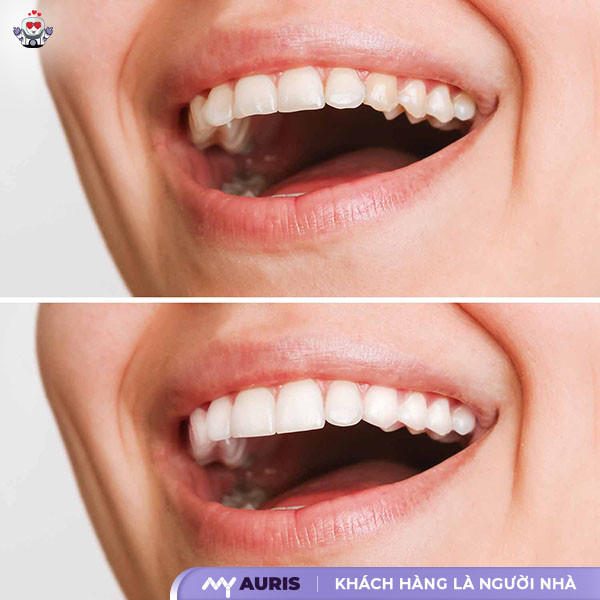 bọc răng sứ cho răng cửa bị mẻ