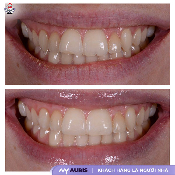 bọc răng sứ cho răng cửa bị mẻ