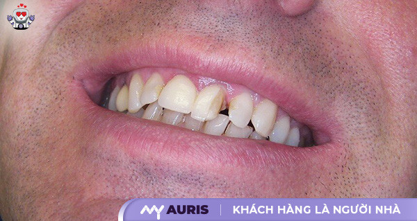 bọc răng sứ cho răng cửa bị mẻ