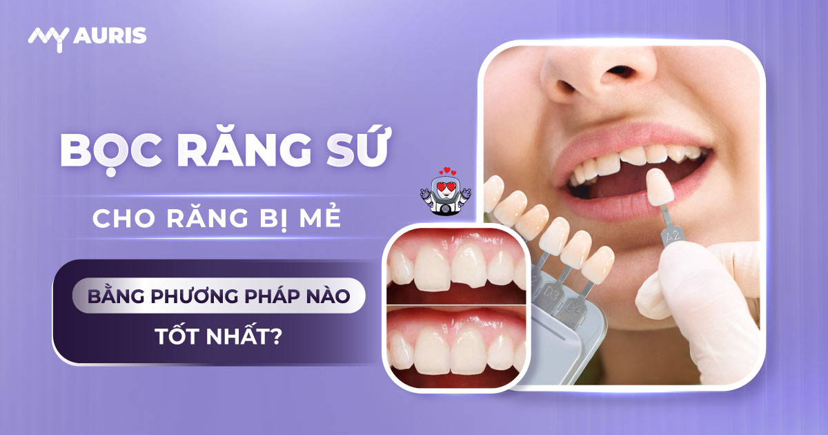bọc răng sứ cho răng cửa bị mẻ