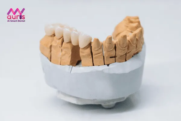 Phục hình răng bằng cầu răng sứ