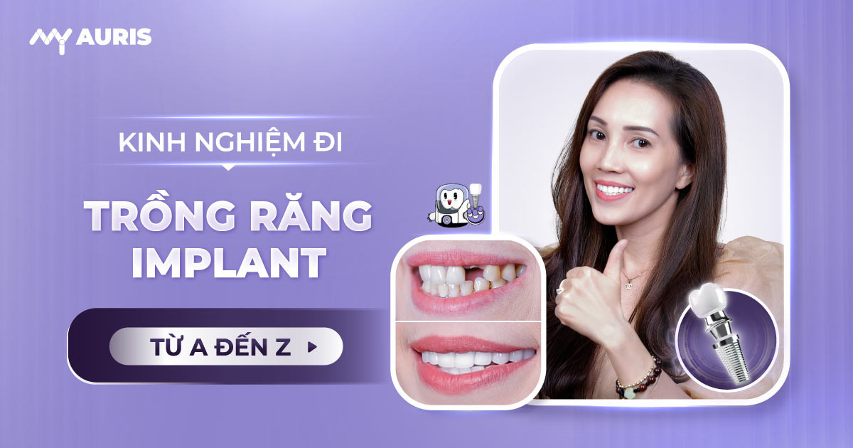 đi cấy implant kinh,nghiệm đi trồng răng implant