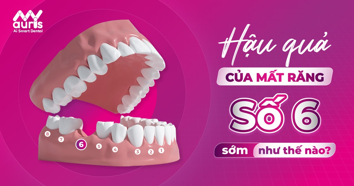 Hậu quả của mất răng số 6 sớm