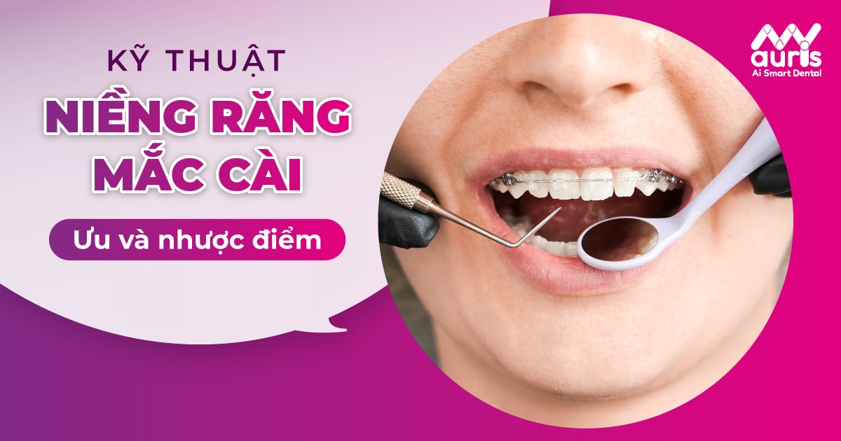 Tìm hiểu thông tin các kỹ thuật niềng răng mắc cài