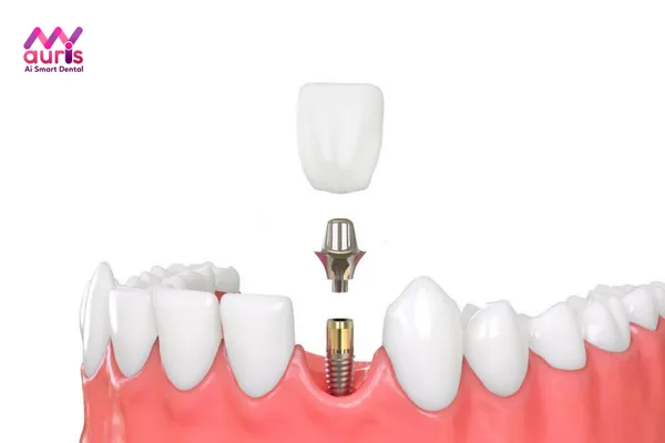 Lựa chọn loại trụ răng Implant phù hợp nhất