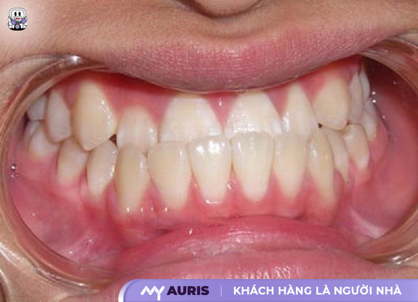 bị móm có nên niềng răng