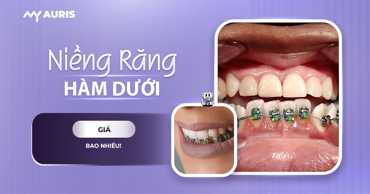 niềng răng dưới giá bao nhiêu,niềng răng hàm dưới giá bao nhiêu,niềng răng bao nhiêu tiền 1 hàm,niềng răng hàm dưới