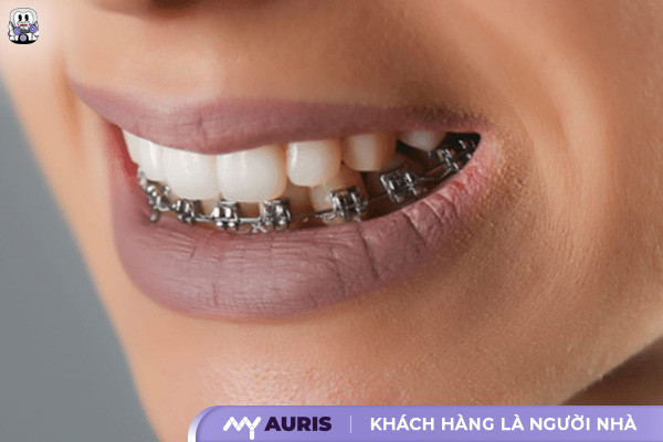 niềng răng dưới giá bao nhiêu,niềng răng hàm dưới giá bao nhiêu,niềng răng bao nhiêu tiền 1 hàm,niềng răng hàm dưới