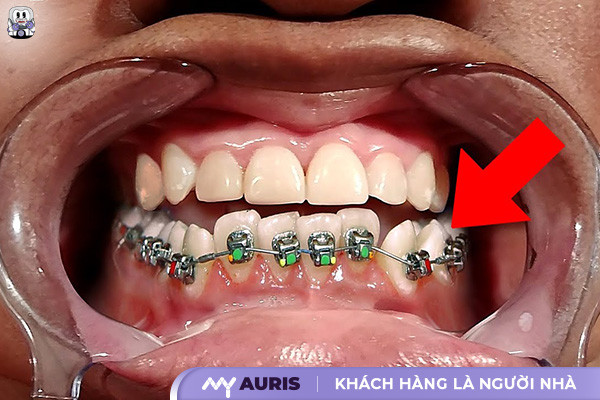 niềng răng dưới giá bao nhiêu,niềng răng hàm dưới giá bao nhiêu,niềng răng bao nhiêu tiền 1 hàm,niềng răng hàm dưới