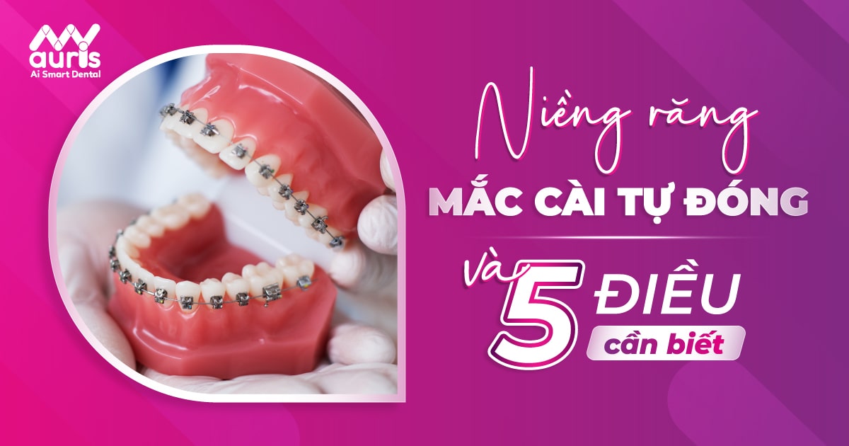 niềng răng mắc cài tự đóng