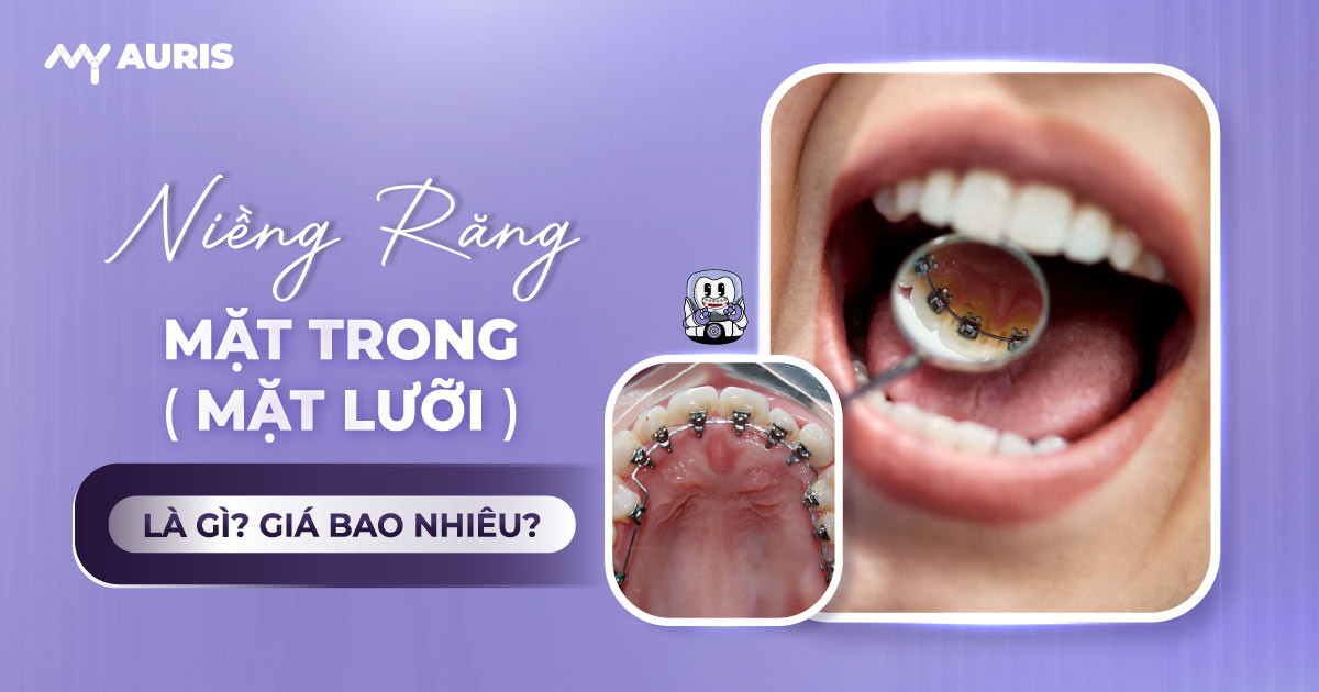 niềng răng mặt lưỡi
