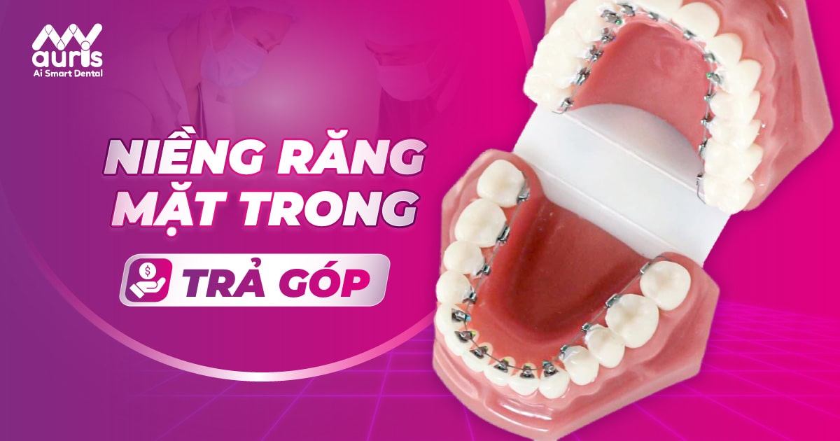 Niềng răng mặt trong trả góp và 3 giai đoạn cần lưu ý