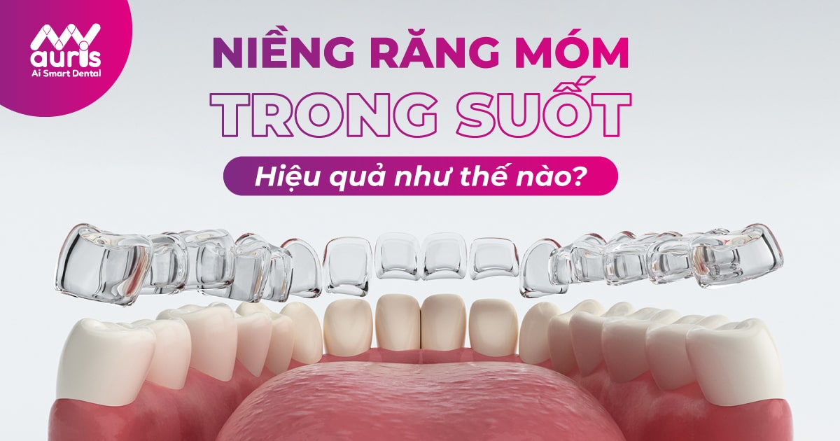 niềng răng móm trong suốt