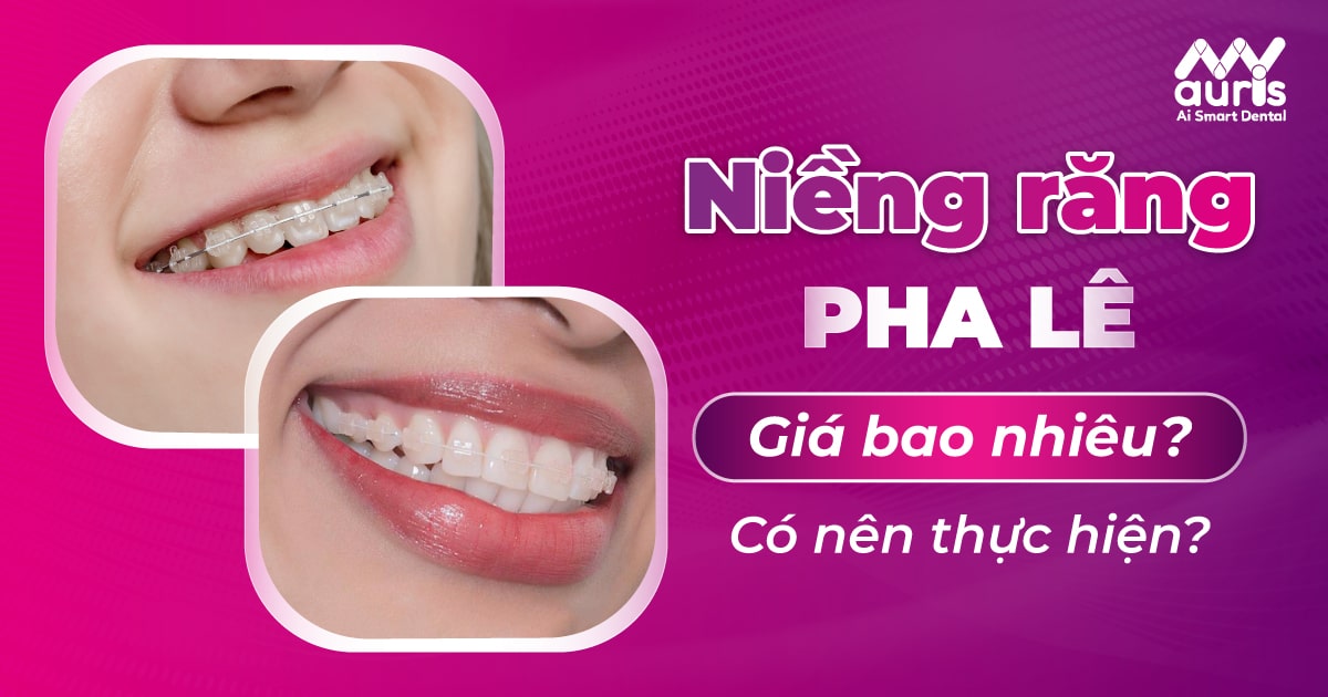 Niềng răng pha lê giá bao nhiêu