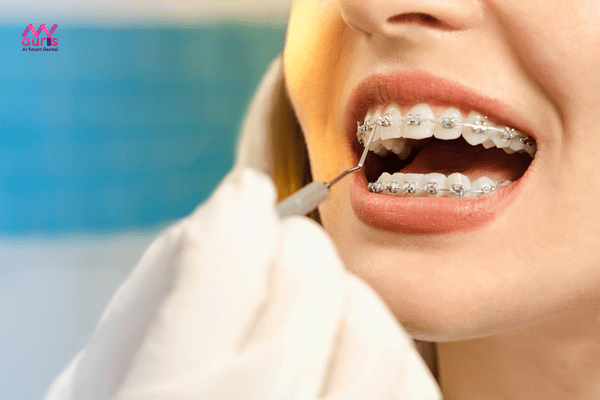quy trình niềng răng móm