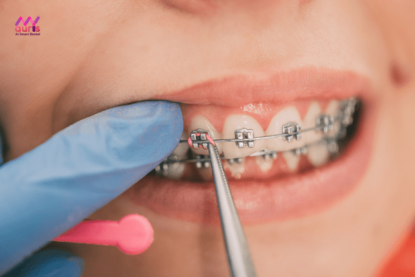 quy trình niềng răng móm