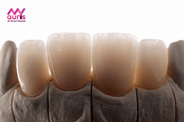 Răng sứ thẩm mỹ là răng gì?