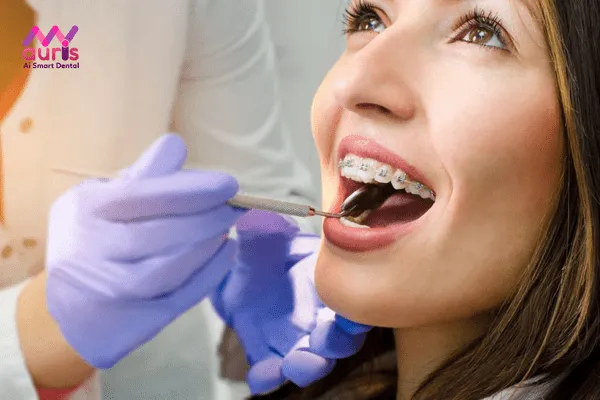 Phương pháp niềng răng chỉnh nha bằng mắc cài kim loại