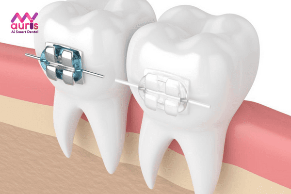 Giải đáp nên niềng răng mắc cài sứ hay kim loại sẽ tốt hơn? Điểm giống nhau