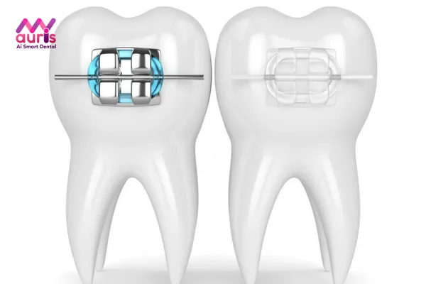 Giải đáp nên niềng răng mắc cài sứ hay kim loại sẽ tốt hơn? Điểm khác nhau
