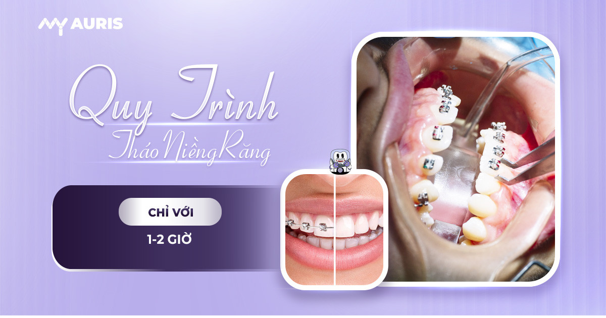 cách tháo niềng răng tại nhà,tháo mắc cài niềng răng,tháo niềng răng