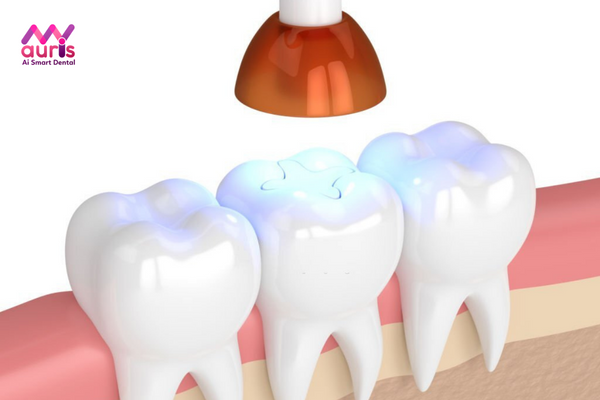 Trồng răng khểnh bằng cách đắp Composite