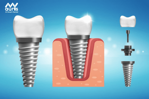 Trồng răng khểnh bằng cách cắm Implant