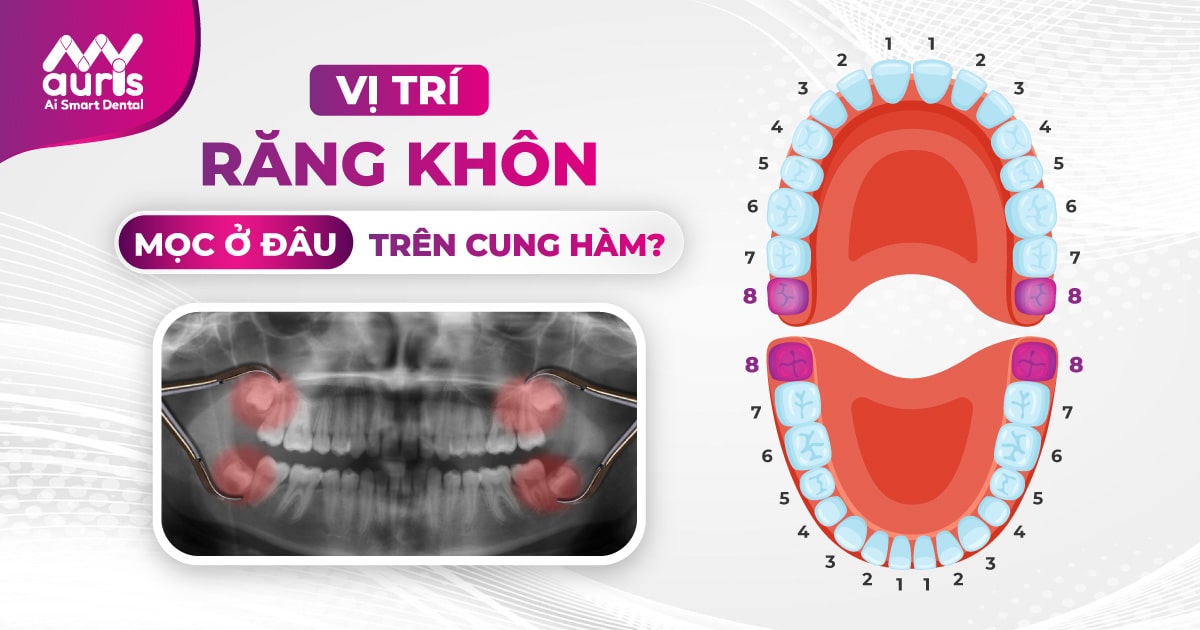 Vị trí răng khôn