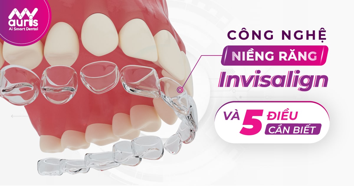 công nghệ niềng răng invisalign