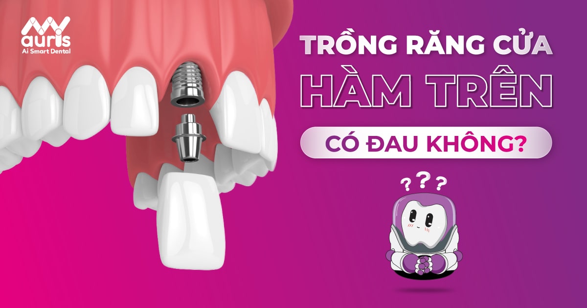 trồng răng cửa hàm trên