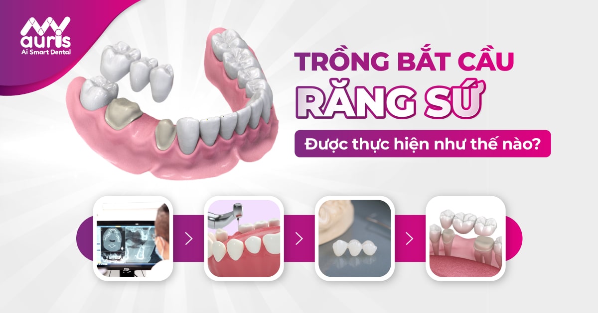 phương pháp trồng răng bắt cầu