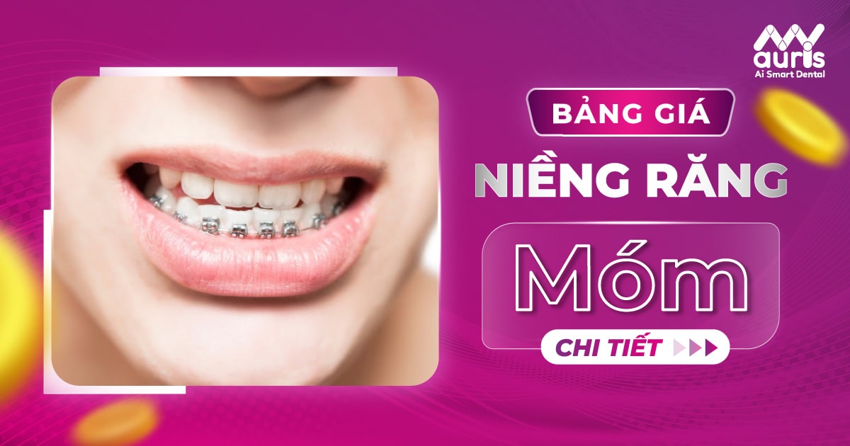 bảng giá niềng răng móm