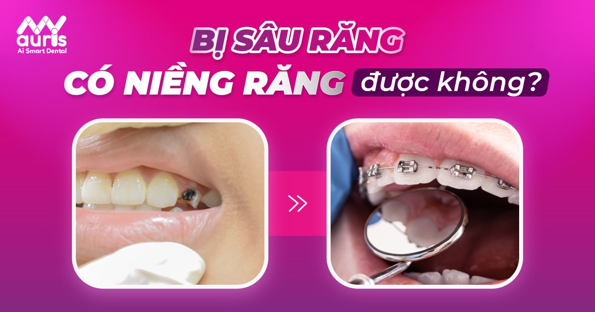 bị sâu răng có niềng răng được không