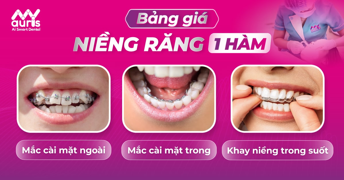 Bảng giá niềng răng 1 hàm với các kỹ thuật phổ biến