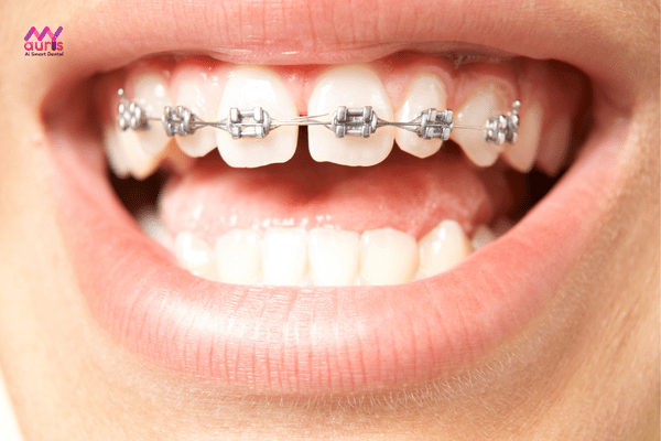 các giai đoạn niềng răng