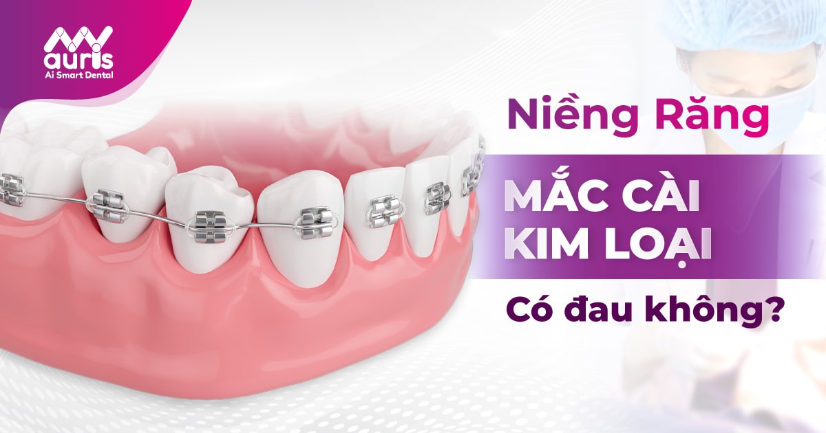 Chia sẻ niềng răng mắc cài kim loại có đau không?