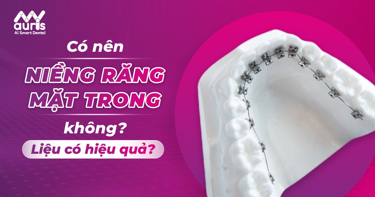 có nên niềng răng mặt trong không