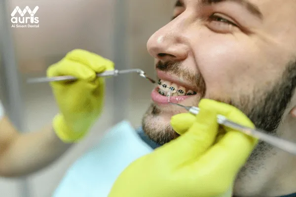 Giá dịch vụ niềng răng với mắc cài kim loại