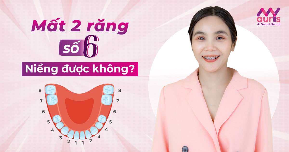 Bác sĩ giải đáp mất 2 răng số 6 có niềng được không?