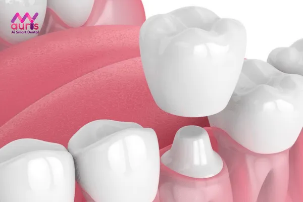Bọc răng sứ sau khi lấy tủy có đau không và có ảnh hưởng gì không?