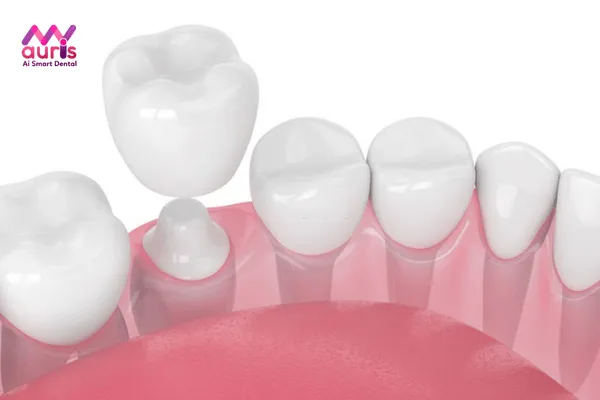 Giải đáp bọc răng sứ sau khi lấy tủy có đau không?
