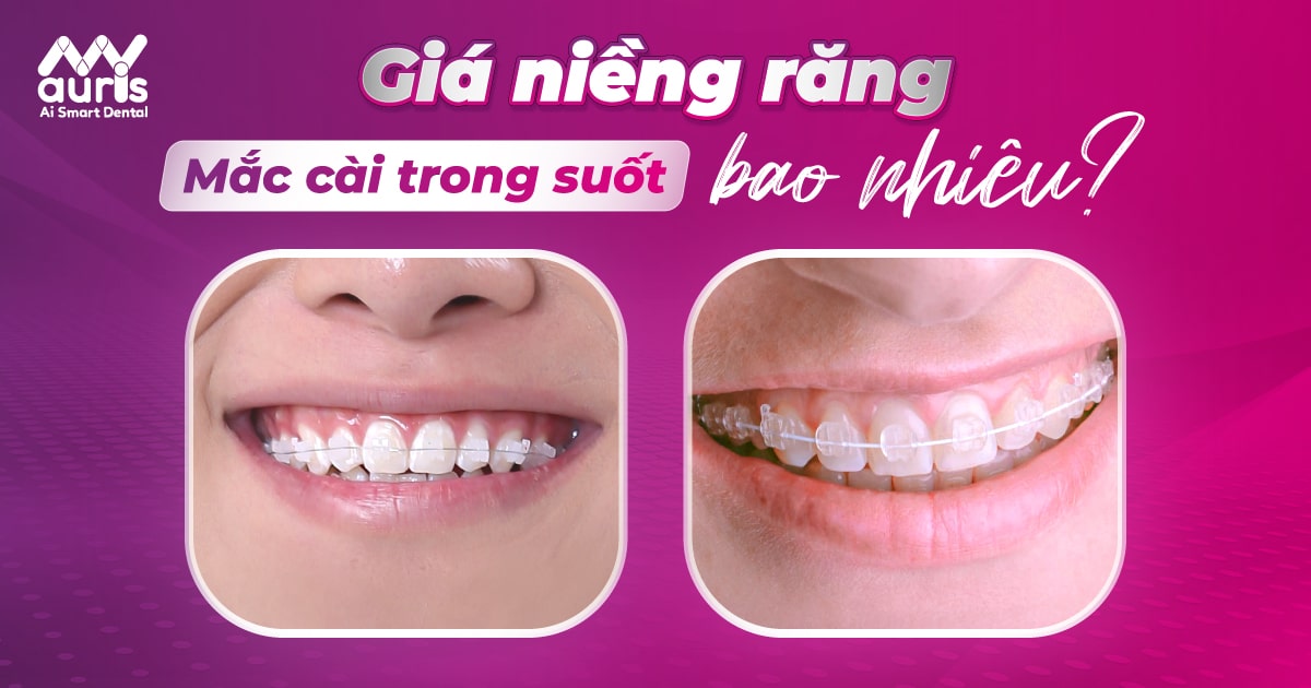 Tìm hiểu giá của niềng răng mắc cài trong suốt bao nhiêu?