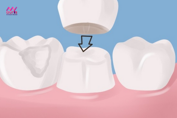 bọc răng sứ cho răng hàm sâu